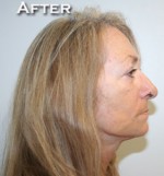 Face Lift