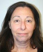 Face Lift
