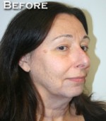 Face Lift