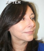 Face Lift