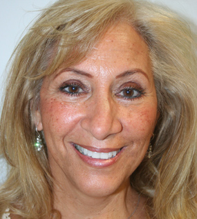 Face Lift