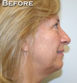Face Lift