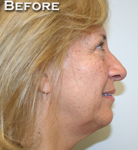 Face Lift
