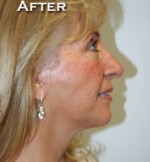 Face Lift