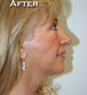 Face Lift
