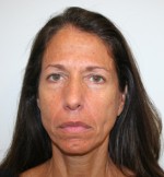 Face Lift
