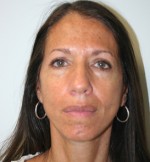 Face Lift