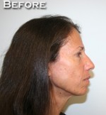 Face Lift