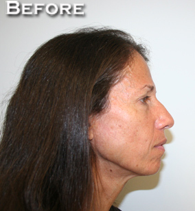Face Lift