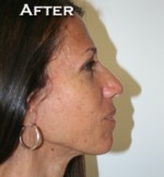 Face Lift