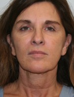 Face Lift