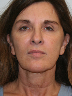 Face Lift