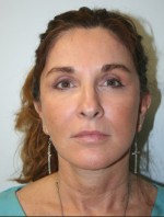 Face Lift