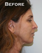 Face Lift