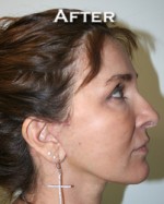 Face Lift