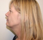 Face Lift