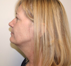 Face Lift
