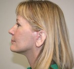 Face Lift