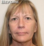 Face Lift