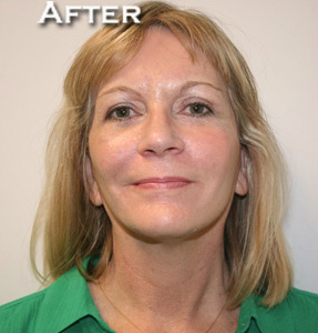 Face Lift