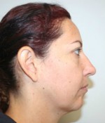 Face Lift