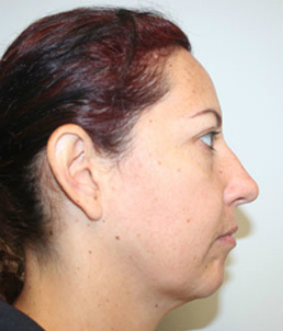 Face Lift