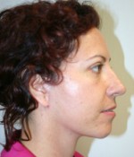 Face Lift