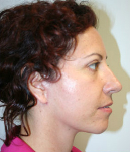 Face Lift