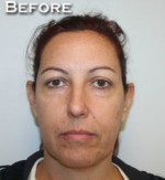 Face Lift