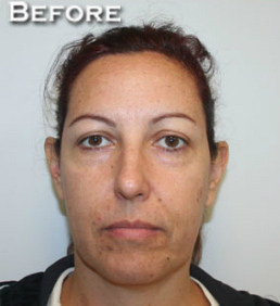 Face Lift