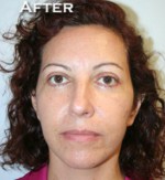 Face Lift