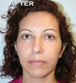 Face Lift