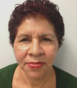 Face Lift