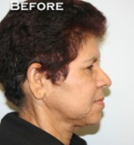 Face Lift