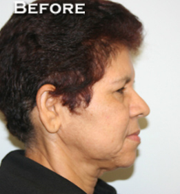 Face Lift