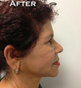 Face Lift