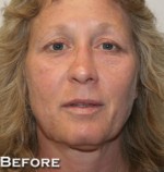 Face Lift