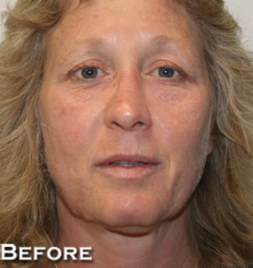 Face Lift