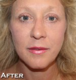Face Lift