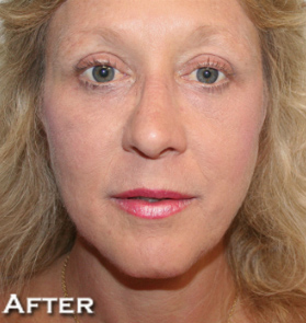 Face Lift