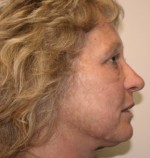 Face Lift