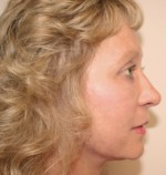 Face Lift