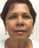 Face Lift