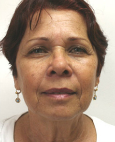 Face Lift