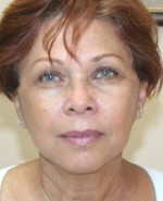 Face Lift