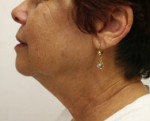 Face Lift