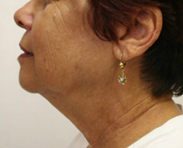 Face Lift