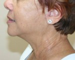 Face Lift