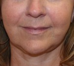 Face Lift