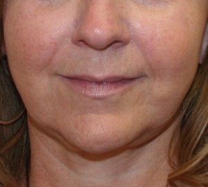 Face Lift